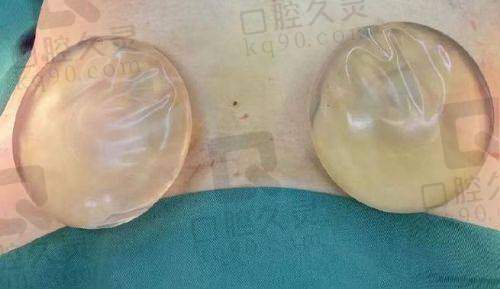 广州中家医家庭医生朱云隆胸手术的费用透明
