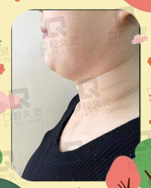 重庆军科整形医院双下巴吸脂体验，轻松告别双下巴，术后脸型紧致效果超棒 