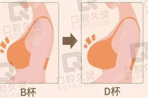 广州中家医家庭医生朱云傲诺拉绚耀假体隆胸87950元起，手术过程揭秘