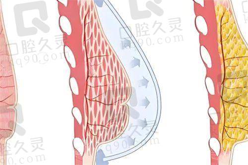 广州中家医家庭医生朱云傲诺拉绚耀假体隆胸87950元起，手术不仅创伤小，术后修复快，确保术后成效的持久性和自然感