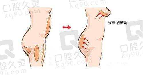 深圳米兰柏羽整形医院电话多少？预约电话0755-****57555，预约服务优质