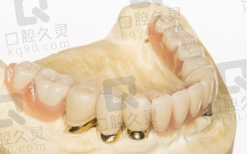 做了烤瓷牙我不想活了的真实实例