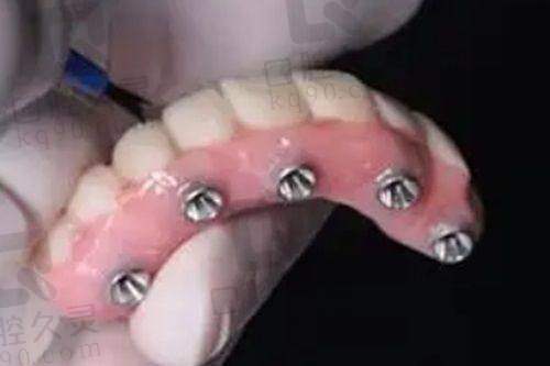 干槽症的典型症状与表现