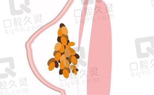 3. 胸部整形项目价格明细
