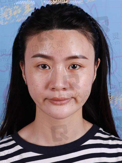 宋建星脂肪填充好吗？35年经验技术高超，成活率高成效自然持久值得一试！ 