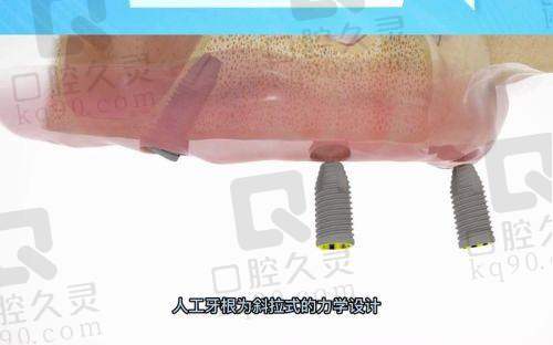 西宁诺贝尔口腔做all-on-4半口种植牙靠谱吗？亲历者术后重拥美牙分享全程体验！