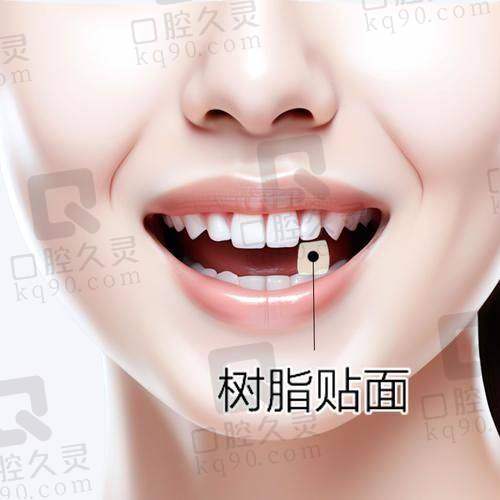 体验天津雅尔口腔医院牙齿贴面美白，轻松拥有自然亮白牙齿，笑容更自信啦！ 