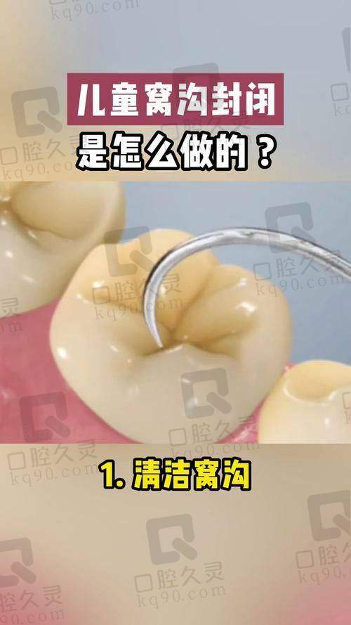 泉州海丝口腔儿童树脂窝沟封闭成效怎么样？