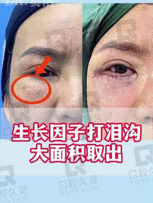 黎星做生长因子取出牛价格公道，失败案例极少，取出干净恢复还快！
