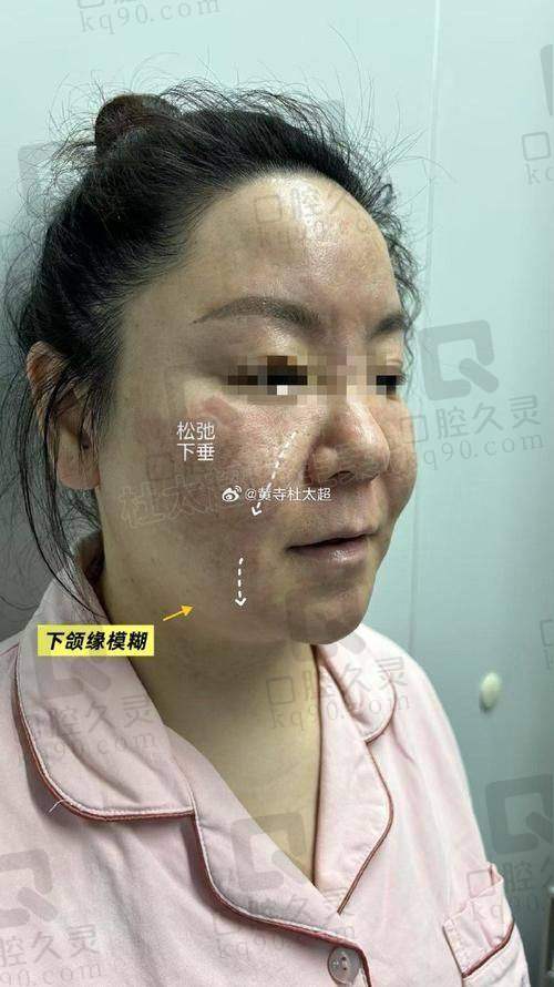 广州中家医家庭医生朱云小切口拉皮提升6750元起的优势