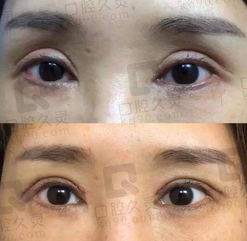 徐晓斐双眼皮修复技术优势