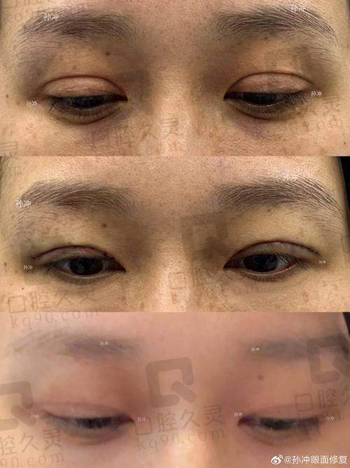 徐晓斐双眼皮修复效果好吗？她擅解各类失败难题，价格实惠预约有门道