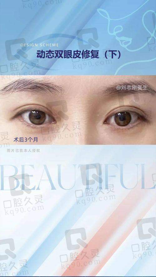 徐晓斐双眼皮修复价格