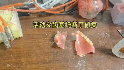 大连国诚口腔医院全口假牙的制作过程是怎样的？