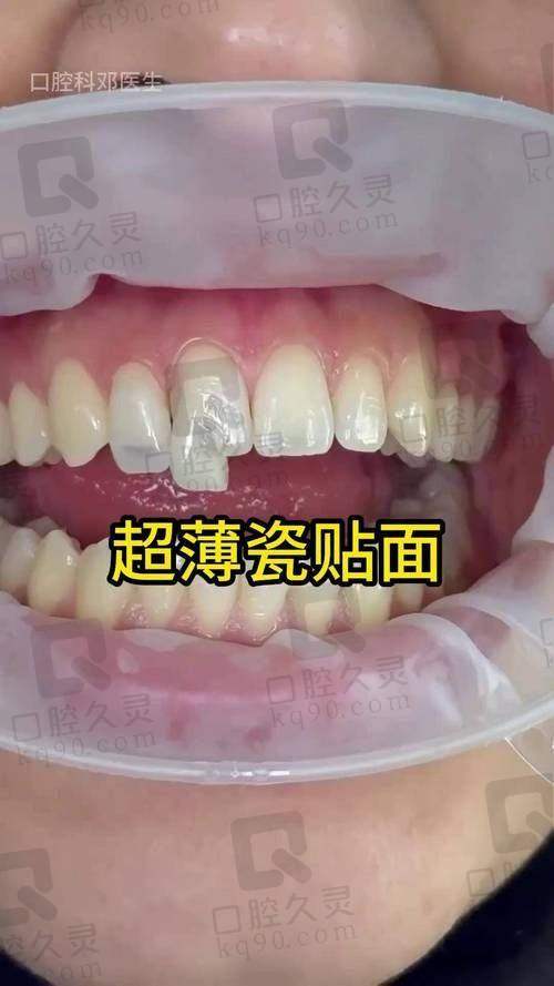 牙齿贴面美白技术特色有哪些？