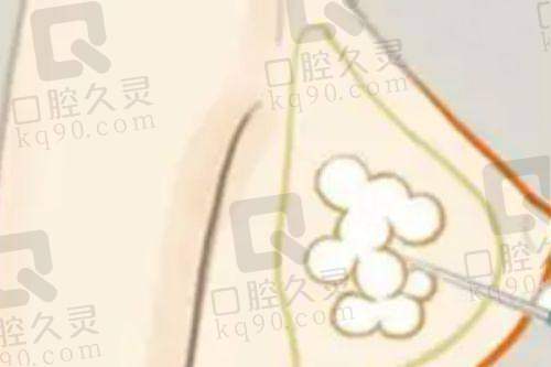 广州中家医家庭医生朱云曼托假体隆胸19750元起，手术技术特色