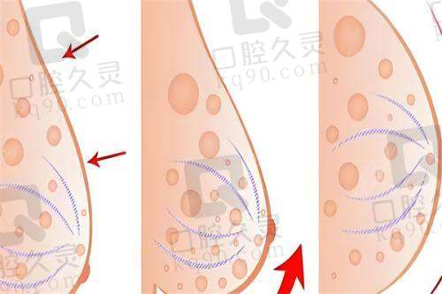 广州中家医家庭医生朱云傲诺拉星熠假体隆胸67950元起的项目价格