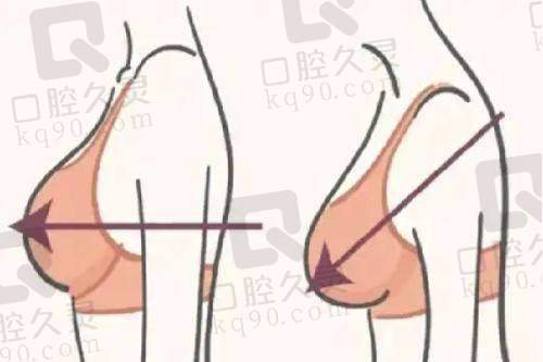 广州中家医家庭医生朱云隆胸手术的实际实例分析