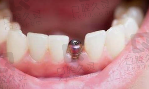 总结：宝鸡团圆口腔医院种植牙值得信赖
