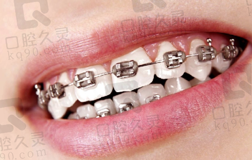 泉州惠安牙名仕口腔医院隐形矫正牙套价格多少?多种品牌可选且收费透明合理