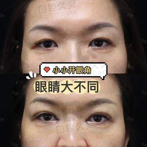 骨干医生技术水平影响留疤情况