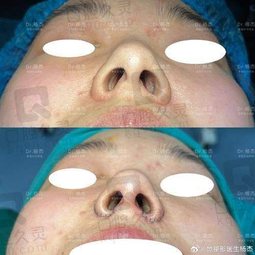 广州中家医家庭医生鼻翼缩小术后护理的重要性