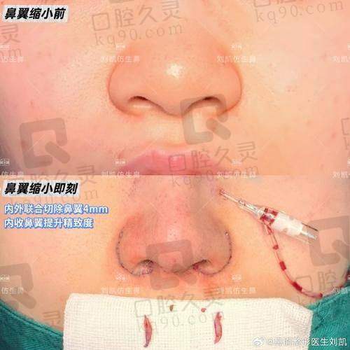 广州中家医家庭医生易普锋鼻翼缩小术后成效显著