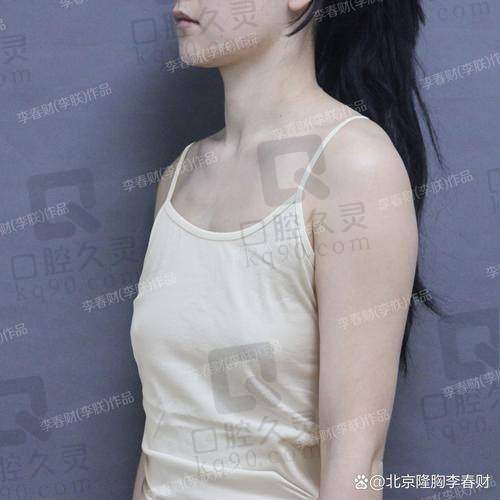 总结：广州中家医家庭医生朱云曼托假体隆胸19750元起，助力女性自信之路