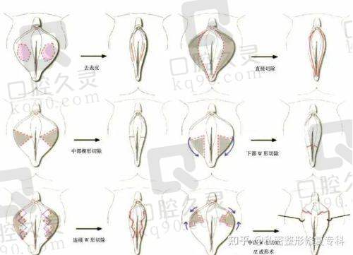 深圳港龙医院是正规私立医院，私密整形技术先进，性价比超高！