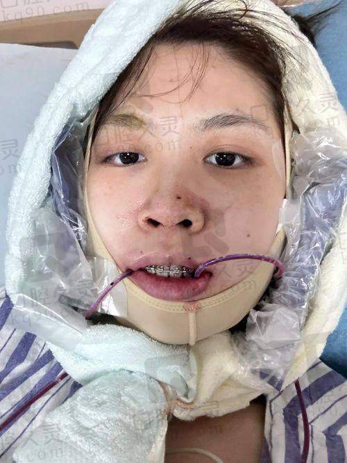广州广大医院正规吗正颌怎么样？正规可靠，3D导板技术+何锦泉医生，正颌优势多价格优 