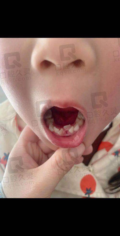 四、医院拔牙疼吗？拔牙前后的注意事项