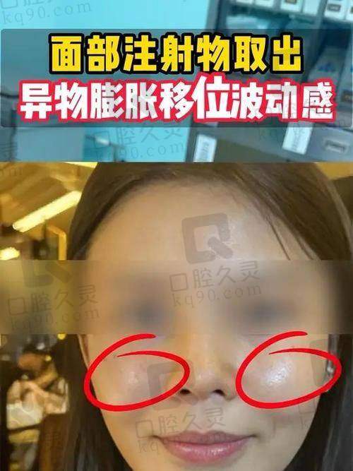 北京王阔远治疗馒化脸怎么样？“表皮-脂肪-筋膜” 三层减容体系效果揭秘！