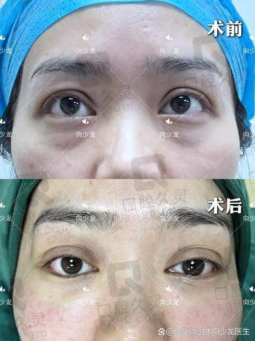 兰州时光整形医院祛眼袋体验分享，轻松告别熊猫眼，术后恢复快效果超自然 