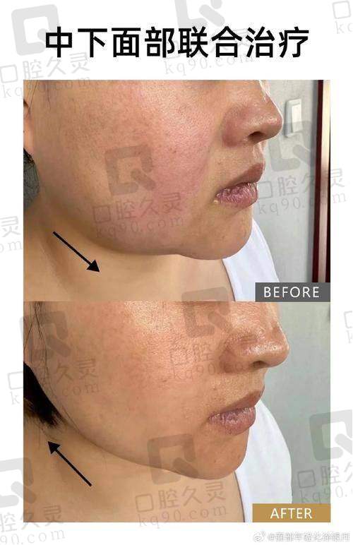 广州中家医家庭医生朱云微拉美埋线面部提升29750元起——技术的独特优势