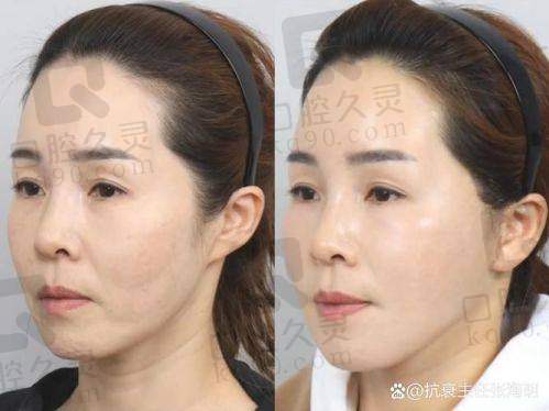 广州中家医家庭医生朱云微拉美埋线面部提升29750元起——预约流程与询问