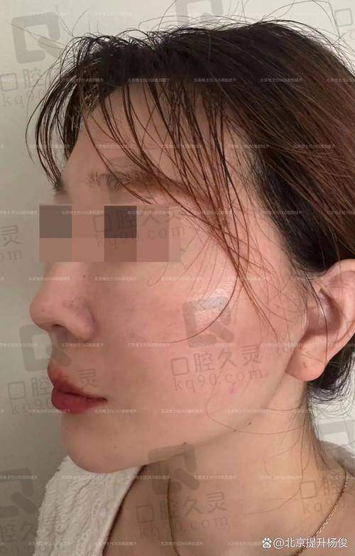 广州中家医家庭医生朱云微拉美埋线面部提升29750元起——经济效率高的价格分析