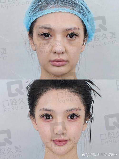 四、北京加减美整形医院苹果肌复位：多种复位方法介绍
