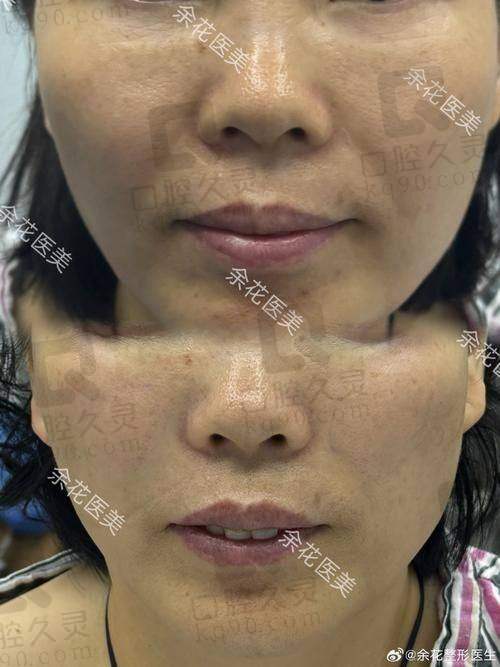 三、北京加减美整形医院苹果肌复位：医生技术超厉害