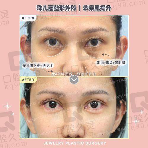 五、北京加减美整形医院苹果肌复位：优势总结