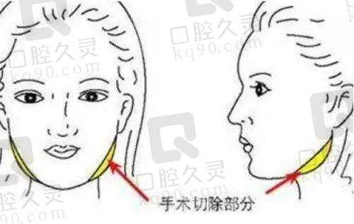 济南艺星做双眼皮的价格合理吗？