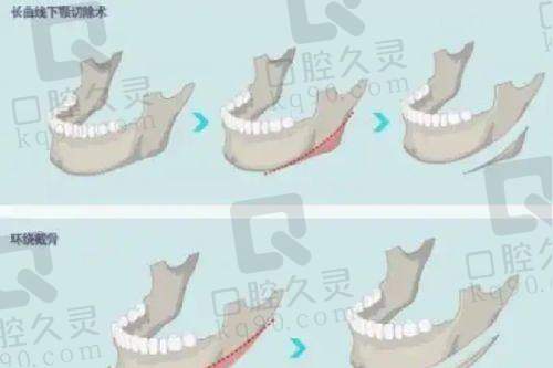 广州中家医家庭医生易普锋自体脂肪全脸填充带来的多重产业价值