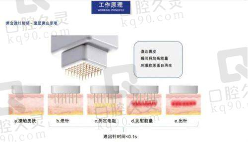 黄金微针治疗后有哪些注意事项？
