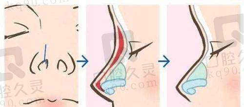 广州中家医家庭医生易普锋自体脂肪全脸填充价格优势分析