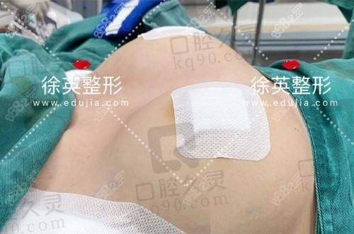广州中家医家庭医生朱云德国宝俪假体隆胸26750元起优势探讨