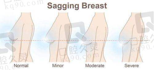 杨季涛医生如何应对胸部提升后的并发症？