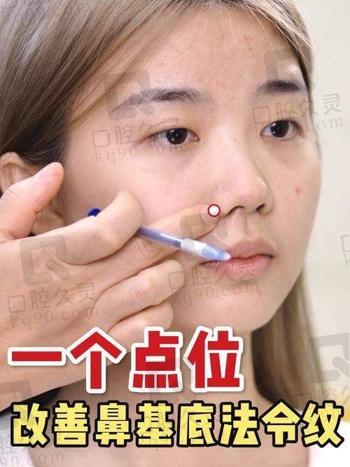 玻尿酸注射去法令纹需要多少毫升？