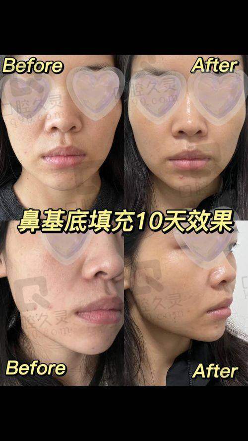 五、选择乔雅登玻尿酸丰脸的注意事项