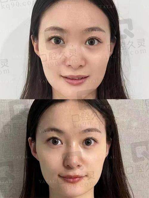 影响濡白天使回落再生时间的因素