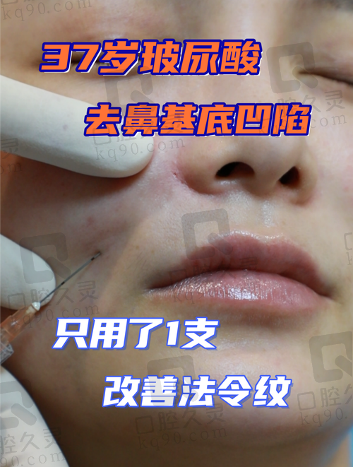 济南艺星玻尿酸注射去法令纹靠谱吗？