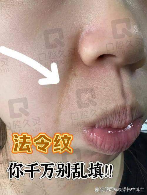 济南艺星玻尿酸注射去法令纹成效如何？